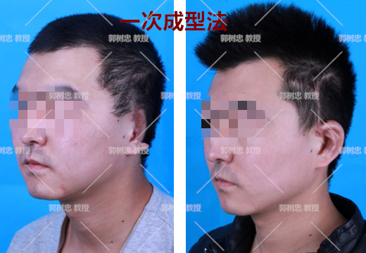 小耳畸形要留还是不留,小耳畸形最新治疗方法