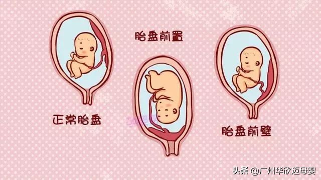 剖腹产想剖就能剖？还要这些医学指征呢