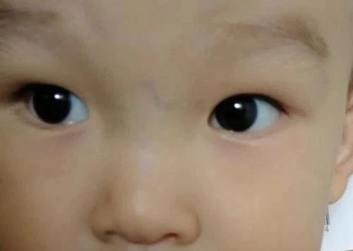 宝宝鼻梁发青是什么原因,婴儿鼻梁发青是什么征兆