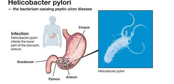 幽门螺旋杆菌呼气试验科普,呼气试验幽门螺旋杆菌有危害吗