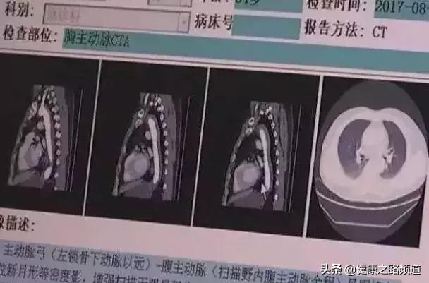 这两个动作会让血栓瞬间脱落,如何防止血栓脱落堵塞血管