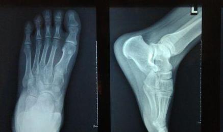 打篮球崴脚了怎么处理,打篮球崴脚脱鞋捏脚