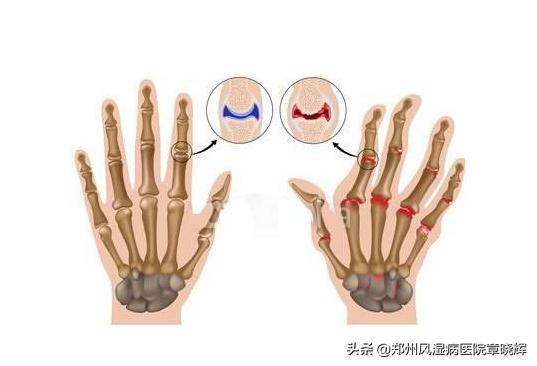大家的类风湿都是怎样治愈的,类风湿性关节炎的几大认识误区