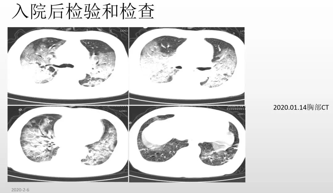 赵建平:重症CAP存在过度炎症反应时合理应用激素可减轻