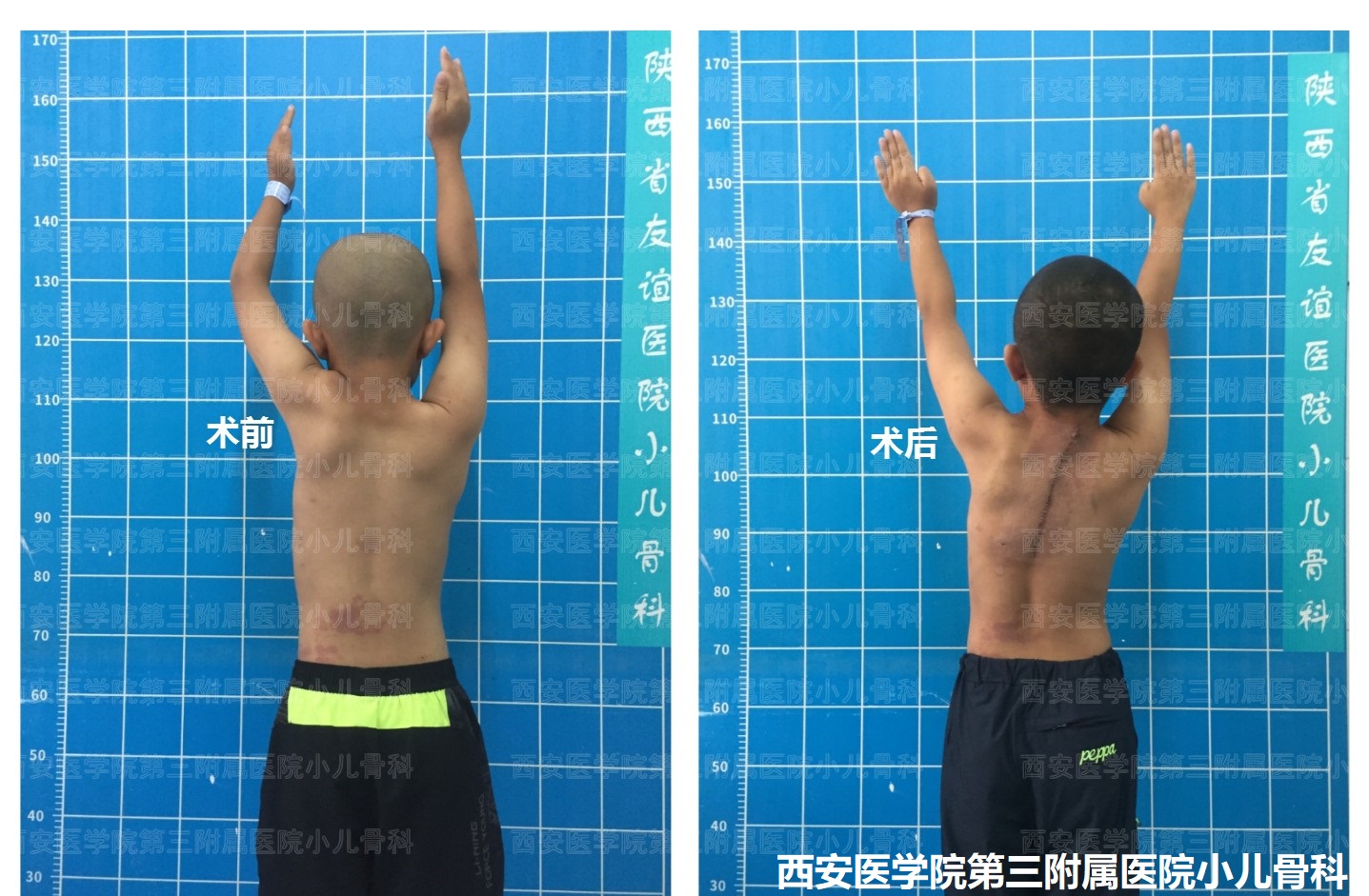 先天性高肩胛手术,先天性肩胛症通过手术需要多少钱