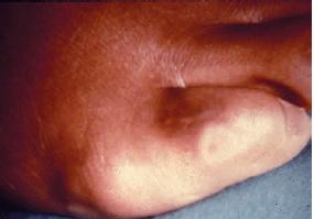 小脚趾滑囊炎警惕四种病,小脚趾拇囊炎怎么治疗