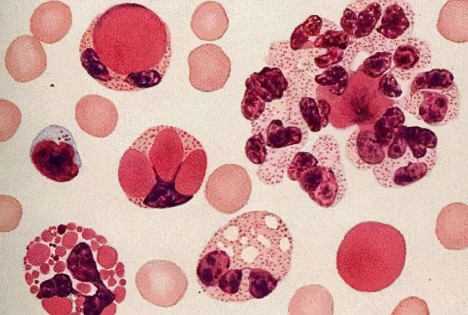 系统性红斑狼疮无法治愈,系统性红斑狼疮能多长时间治好