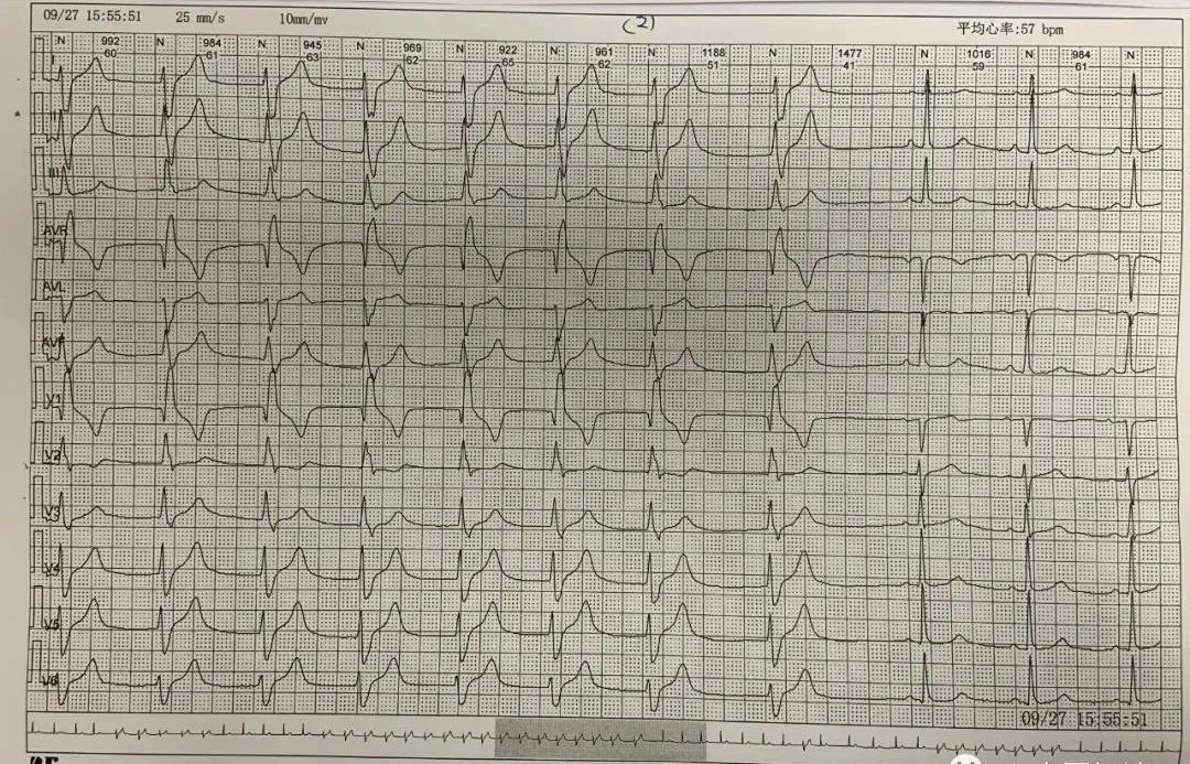 三度房室传导阻滞交界性逸搏,加速的室性逸搏心律的心电图表现