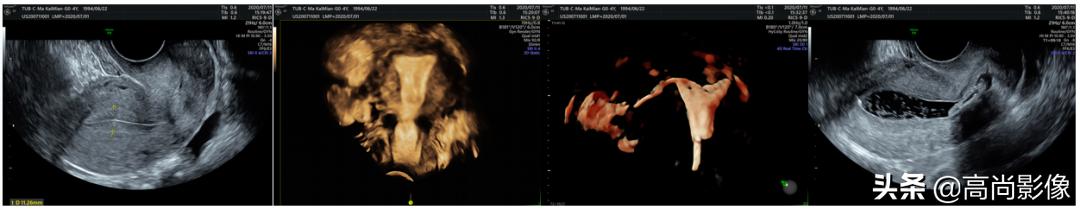 三维超声子宫输卵管造影诊断教学,输卵管超声造影新技术学习班
