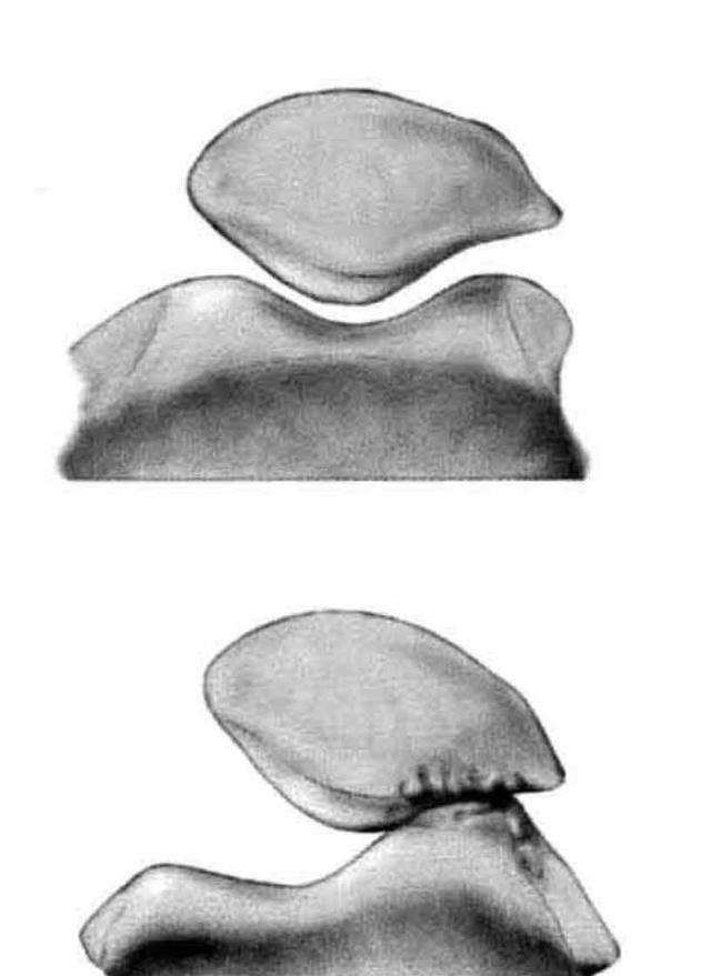 膝盖一弯曲就疼一招解决,膝盖走路一弯曲就疼怎么办
