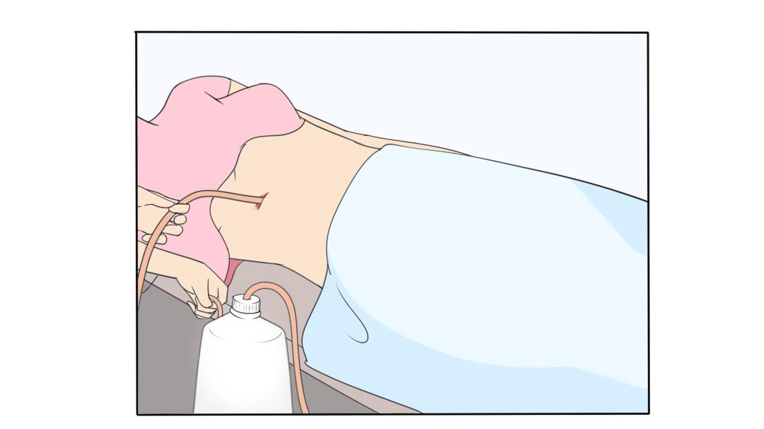 乳腺癌复发转移胸腔积液能活多久,乳腺癌手术后有皮下积液怎么消退