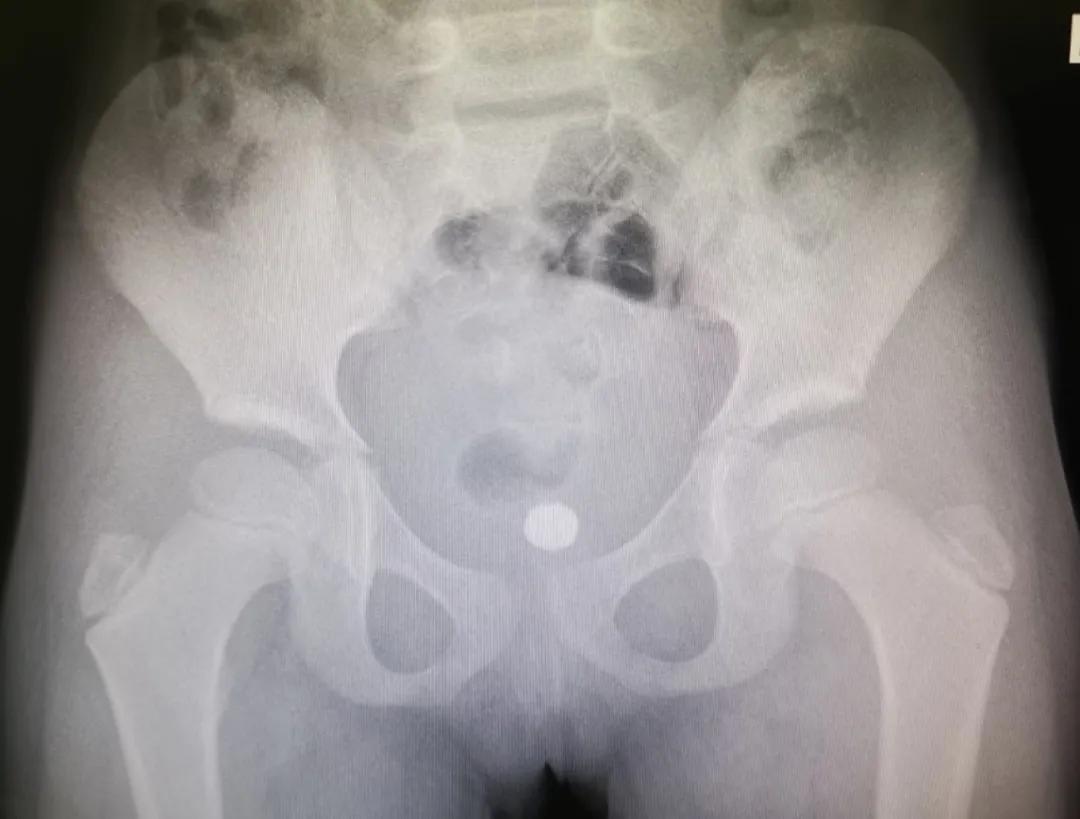 四岁孩子耳朵里塞进钢珠,小男孩往泥巴里塞6个钢珠