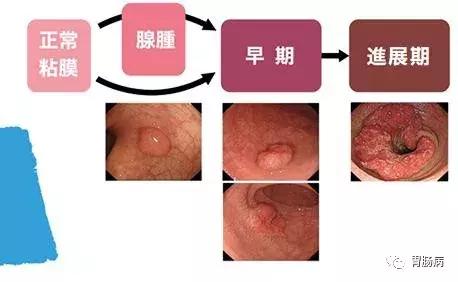 息肉明明切除了，为啥还是得了大肠癌？
