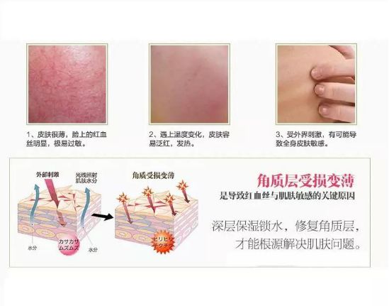 角质层薄适合的水,角质层过薄怎么办有什么方法