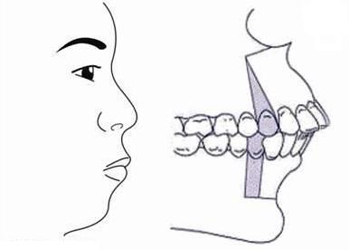 整齐的龅牙影响咬合,严重龅牙用隐形矫正有效果吗