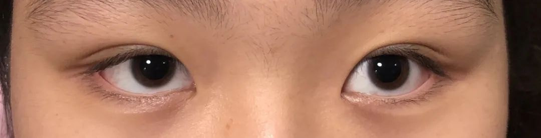 近视600多度用低浓度阿托品有效吗,0.05低浓度阿托品治疗近视的原理