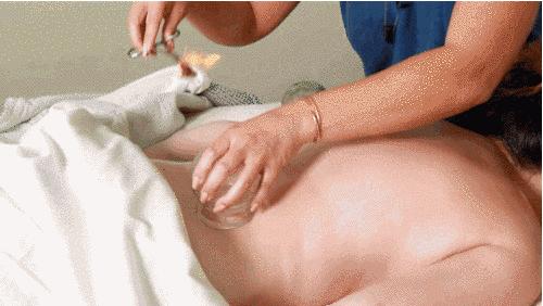 邓莎被烧伤原因,邓莎拔火罐被烧伤视频