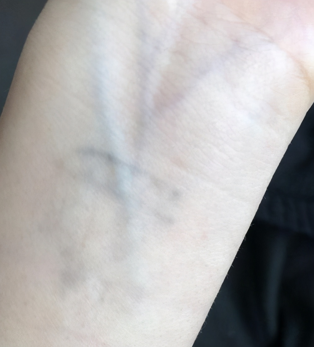 洗纹身不留疤会不会留印记,洗纹身最好的方法不留疤是真的吗