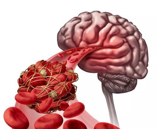 脑梗是“拖”出来的？脑梗来临前有哪些迹象？早知早受益