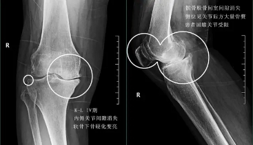 关节炎可以通过打抗生素治疗吗,关节炎治疗的注意事项