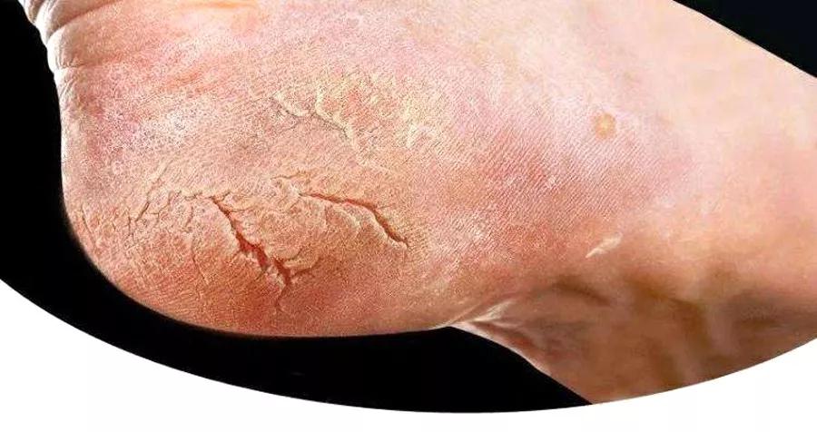 冬季脚跟皲裂怎么回事,天气冷脚皮肤干燥痒怎么办