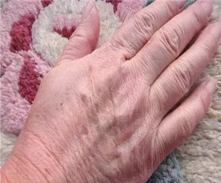 天气一冷手就干裂怎么办,天气一冷手皮肤起皱