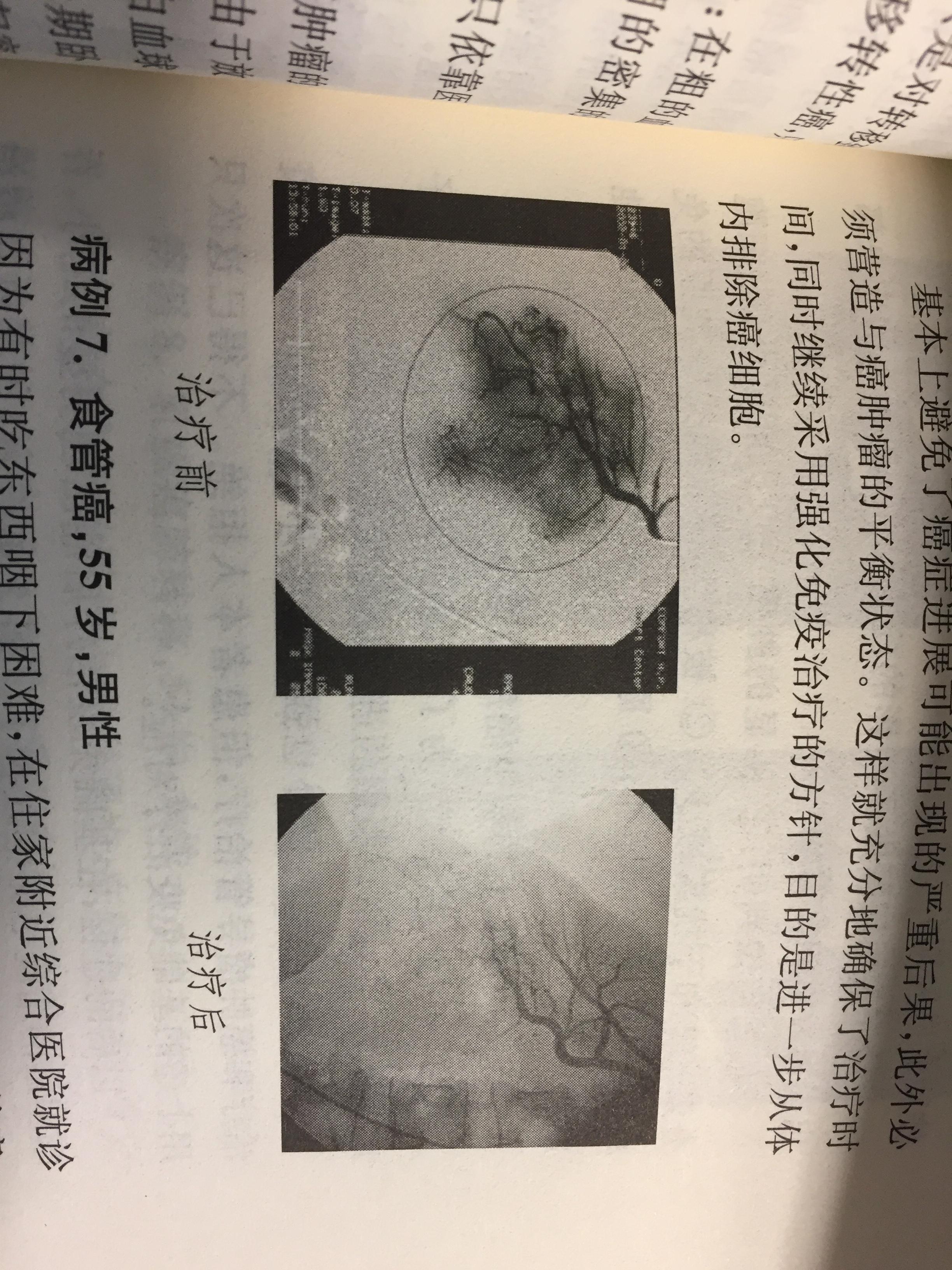 癌症患者免疫治疗的过程,癌症的介入治疗的风险与并发症