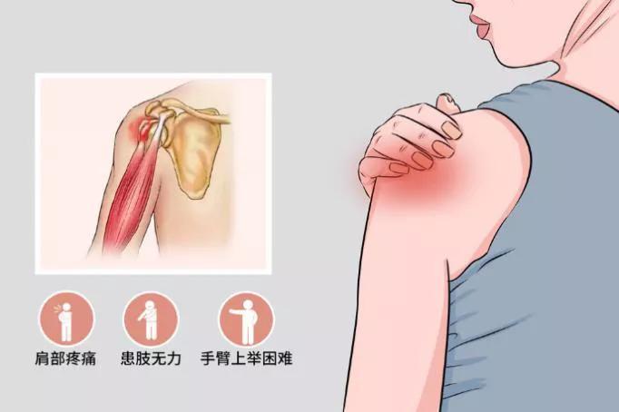 肩钙化性肌腱炎术后疼痛,肩钙化性肌腱炎