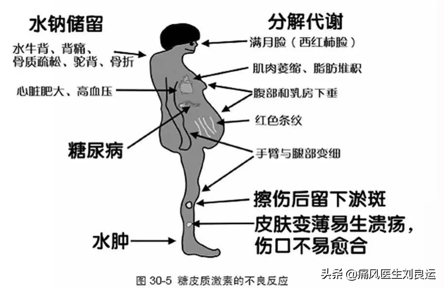 地塞米松可以治疗痛风发作吗,痛风打地塞米松的副作用