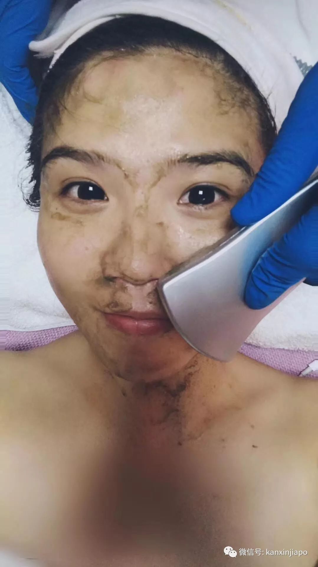 额头长闭口毛孔粗大爆痘怎么办,皮肤爆痘起闭口怎么回事