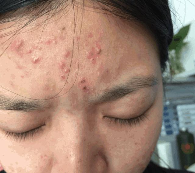 有黑头和没黑头有什么区别,没有长过黑头却长黑头怎么办