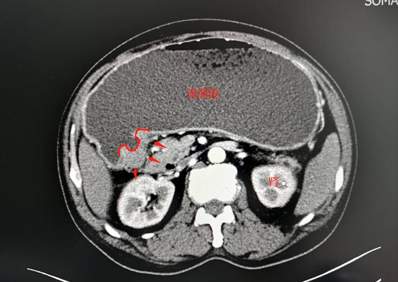 揭秘暴饮暴食引发的疾病,暴饮暴食又吃辣对身体有啥伤害