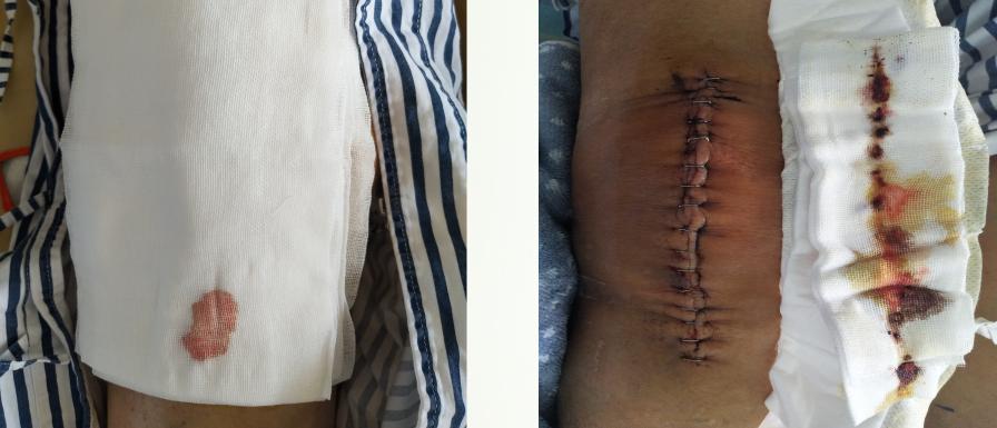 骨科手术病人术前宣教内容,骨科关节科普宣教小知识