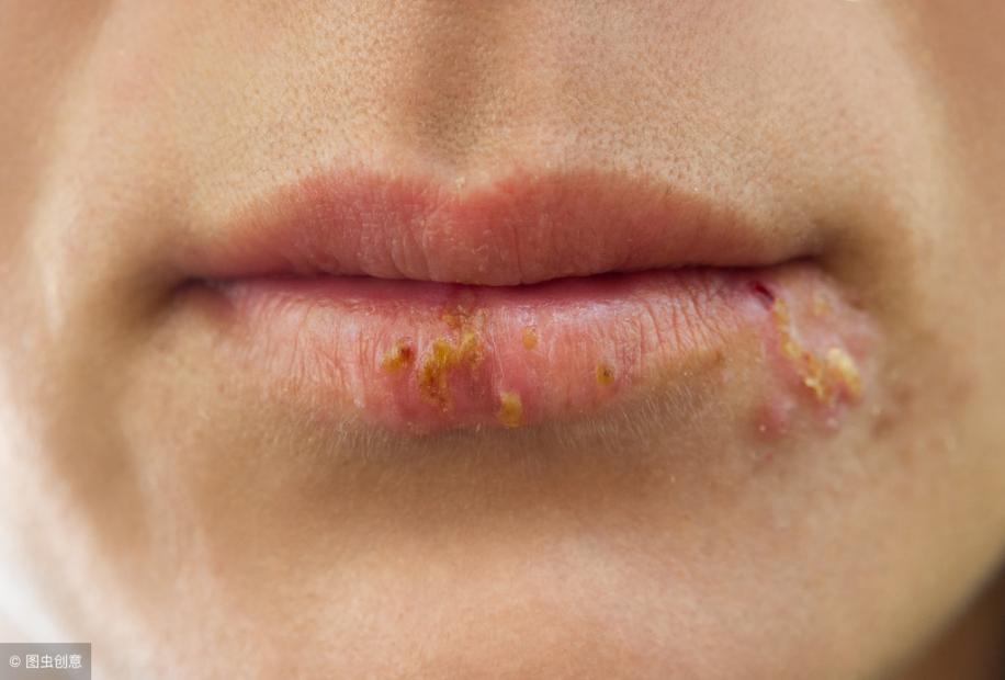 口唇疱疹恢复过程,口唇疱疹怎么断根