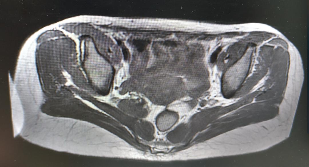 盆腔包块怎么得的,病例分享案例