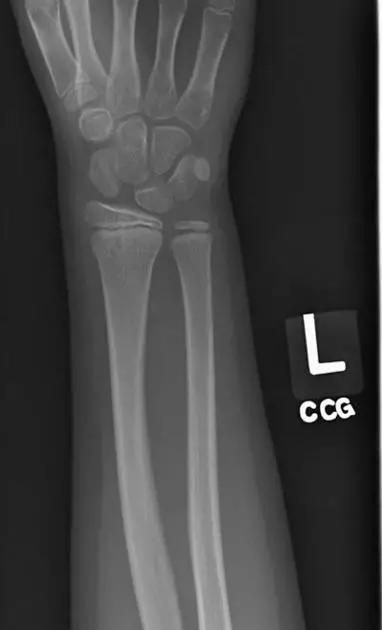 所有骨折都叫什么名字,骨折的名称有哪些