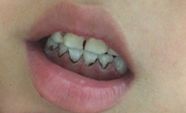 孩子牙菌斑怎么清除,孩子牙菌斑