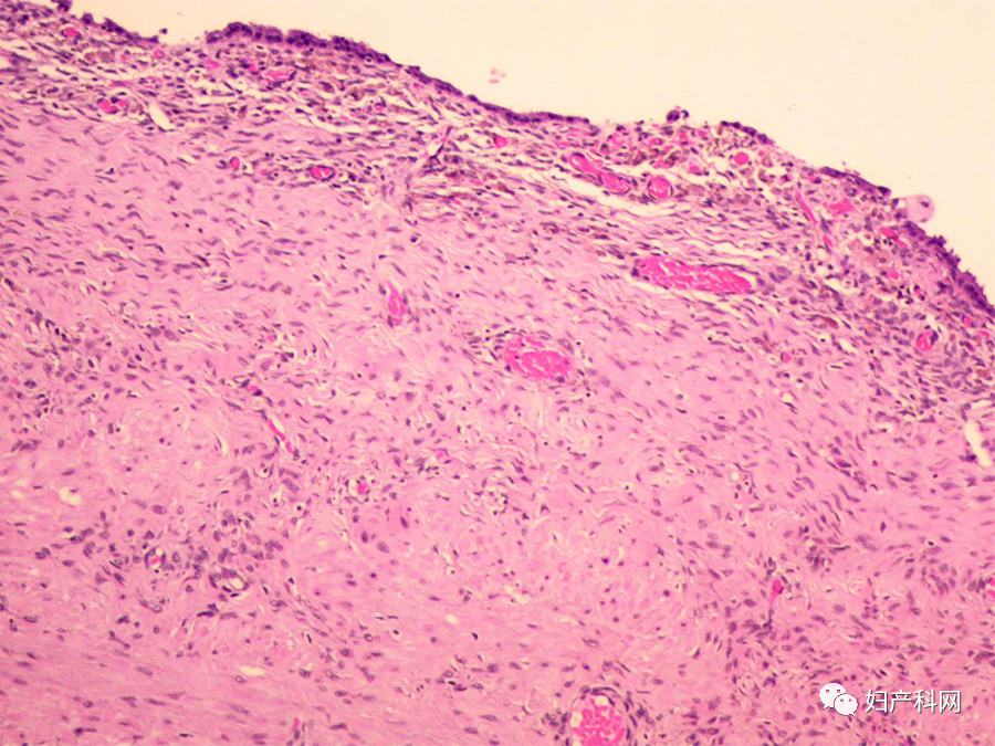 轻微子宫内膜异位症病历单,病理报告子宫内膜异位囊肿