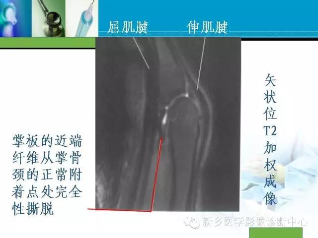 单只手指磁共振,手指用磁共振能做出来结果吗