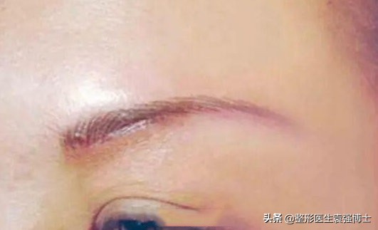 提眉手术拆线疼不疼,提眉手术20多天了怎么还感觉疼