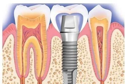 疫情期间无法看牙,疫情期间没看好的牙怎么办