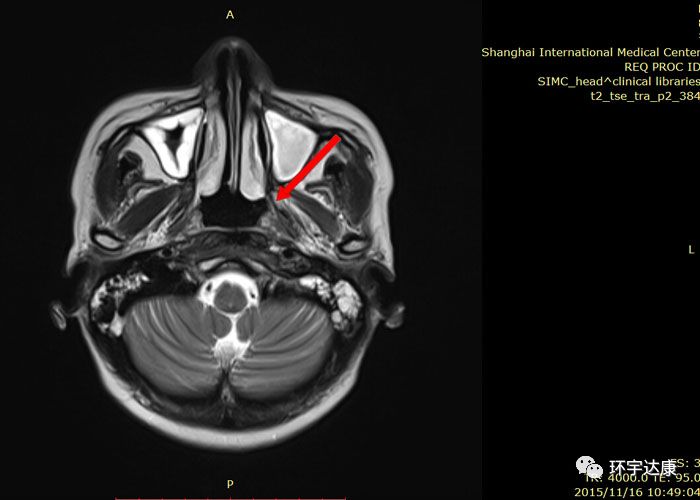 全国治疗鼻咽癌排行榜,鼻咽癌全球发病率最高的地区是
