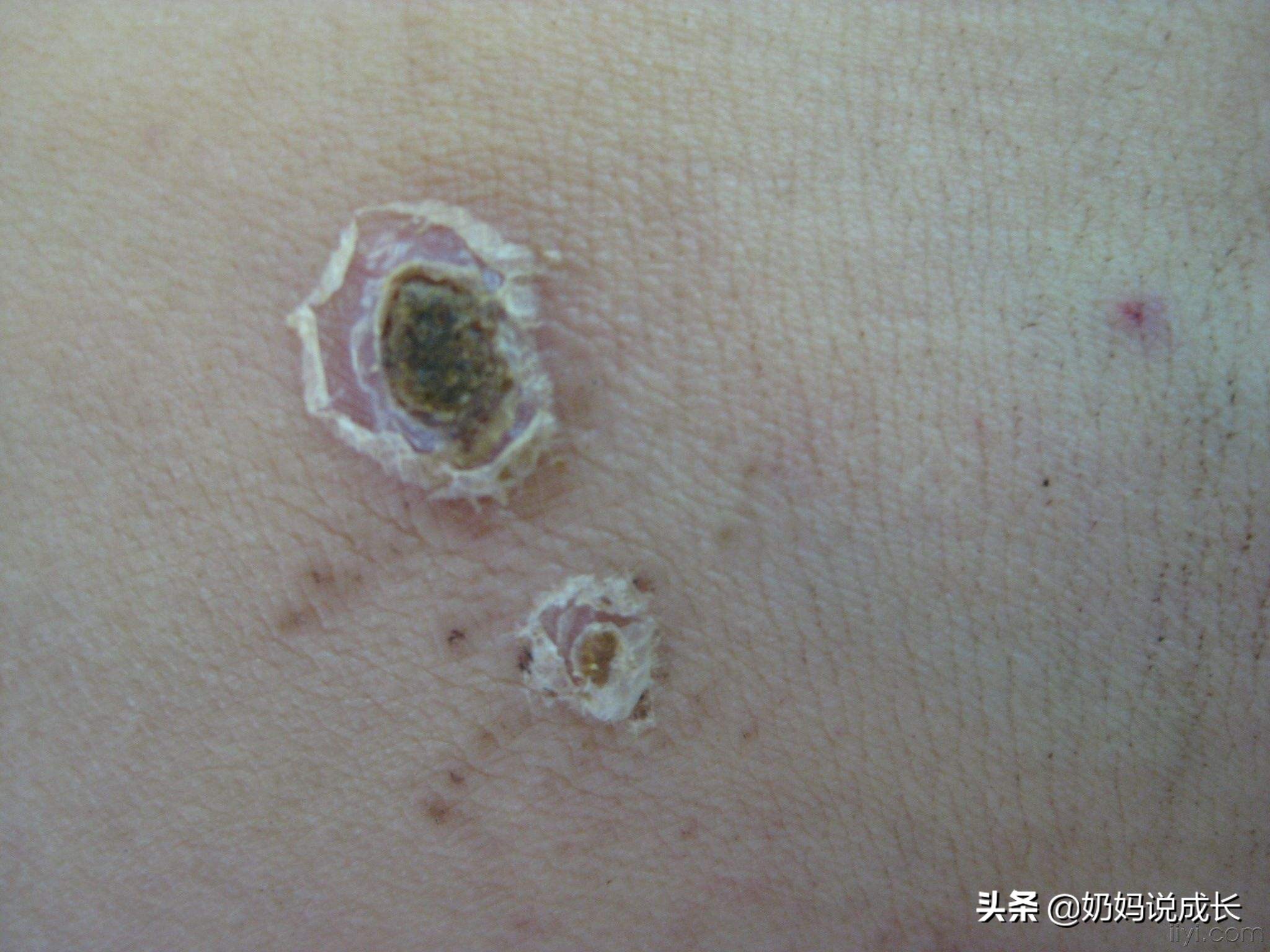 男孩被咬伤,被虫子咬了出现什么症状需要就医