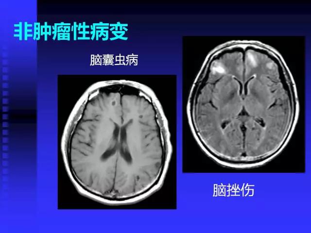 头颅mri读片视频教程,颅脑mri读片入门教程视频讲解全集
