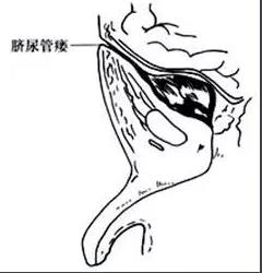 脐部护理的介绍,新生儿脐部护理