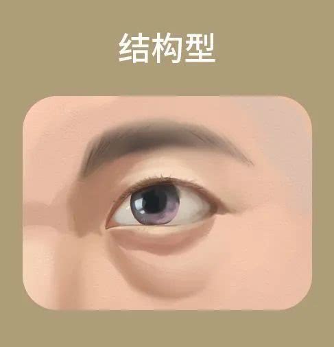 黑眼圈的原因以及解决办法,黑眼圈最近越来越严重怎么解决