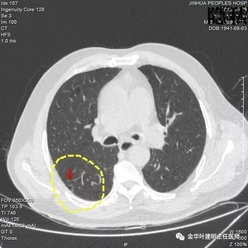 警惕-会是简单的肺大泡吗？