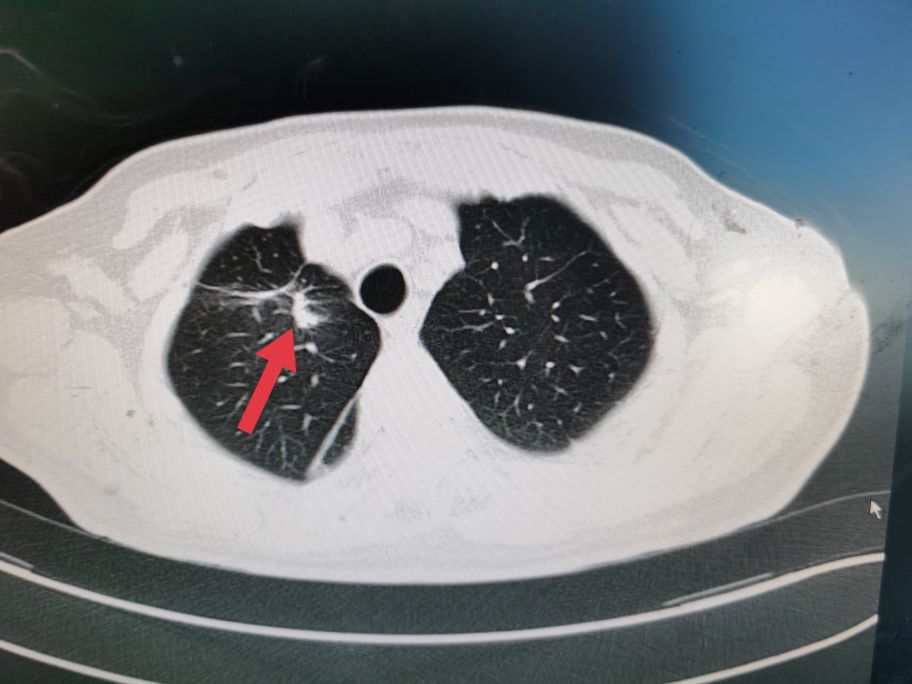 贲门癌吐血抢救,中国最著名的贲门癌治疗专家