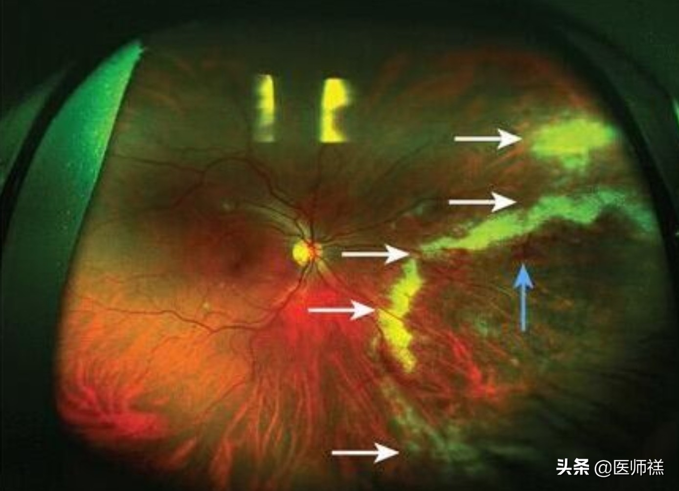 医学名词详解13：感染持续终生的HCMV