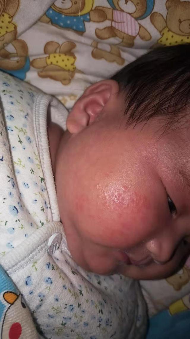 小儿湿疹需要干燥还是保湿,夏季干性湿疹宝宝怎么治